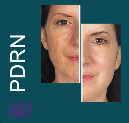 mesothrapy-pdrn-before-after